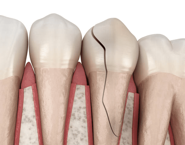 an image showing a cracked tooth from top to bottom